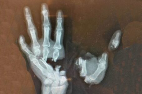 Ovako izgleda šaka dečaka koju je uništila eksplozija petarde